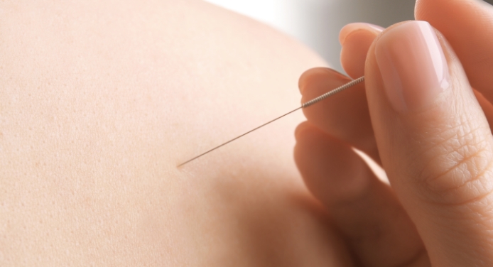 Dry Needling Fysio Balijelaan